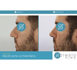 Rinoplastia - Solesio Clinic