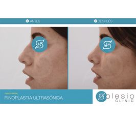 Rinoplastia - Solesio Clinic