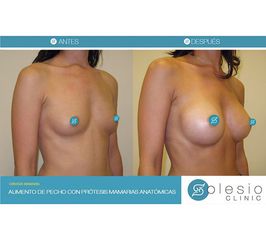 Aumento de pecho - Solesio Clinic