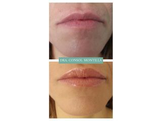 Aumento de labios - Dra. Consol Montilla