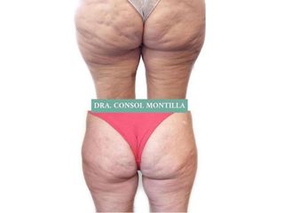 Tratamiento anticelulitico - Dra. Consol Montilla