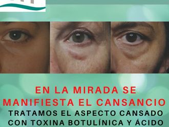 Eliminación ojeras - 808783
