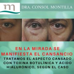 Eliminación de ojeras - Dra. Consol Montilla