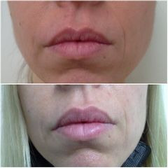 Aumento de labios - Dra. Consol Montilla