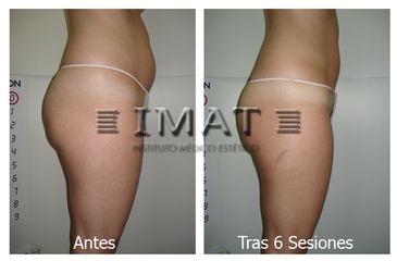 Antes y después Lipocavitación