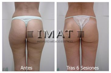 Antes y después tratamiento celulitis