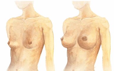 Cirugía mamaria