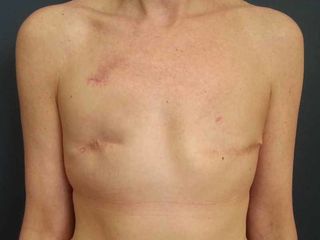 Pre reconstruccion tras mastectomia