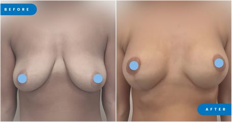 Mastopexia - Dr. Palacios Ortega