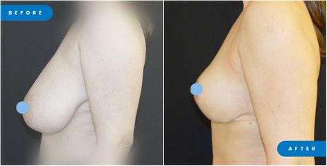 Mastopexia - Dr. Palacios Ortega