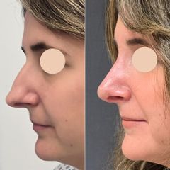 Rinoplastia 14 días