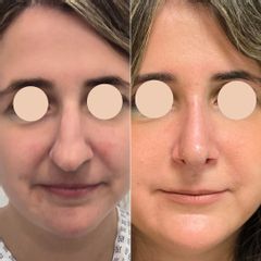 Rinoplastia 14 días