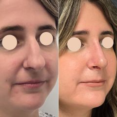 Rinoplastia 14 días