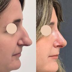 Rinoplastia 14 días