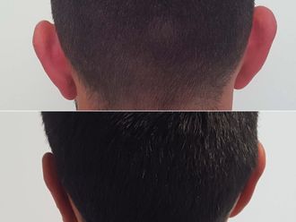 Otoplastia antes y después - 878514