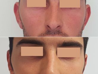 Otoplastia antes y después - 878515