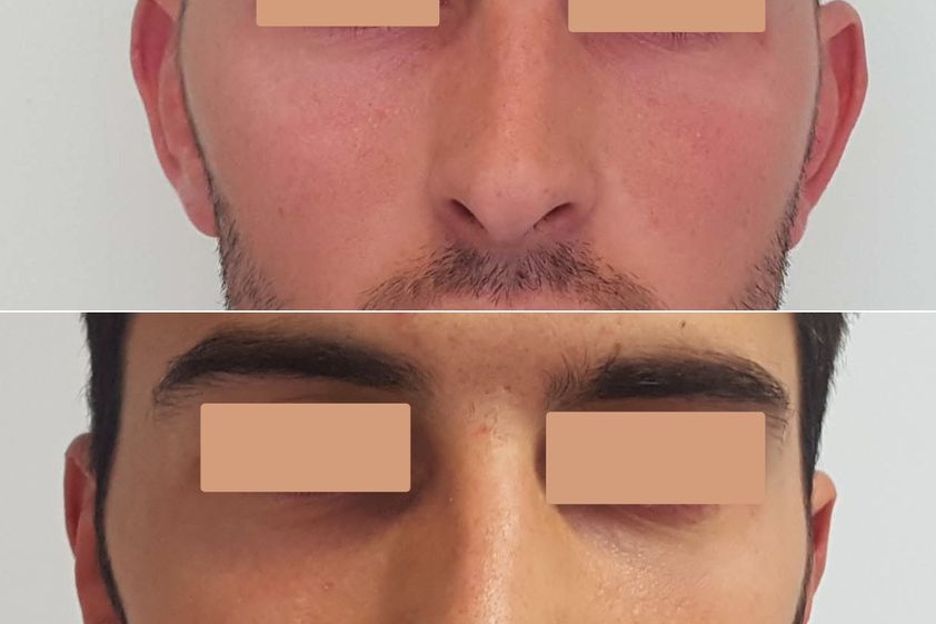 Otoplastia antes y después - 878515