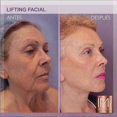 Antes y después Lifting facial - Dr. Ivan Mañero