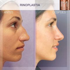 Antes y después Rinoplastia - Dr. Ivan Mañero