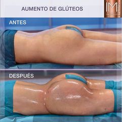 Antes y después Aumento de glúteos - Dr. Ivan Mañero