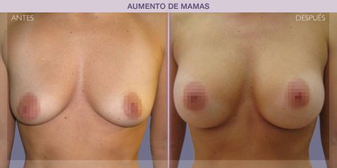 Antes y después Aumento de pecho - Dr. Ivan Mañero