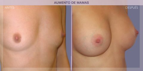 Antes y después Aumento de pecho - Dr. Ivan Mañero