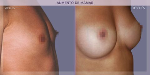 Antes y después Aumento de pecho - Dr. Ivan Mañero