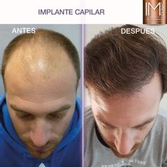 Trasplante capilar - IM CLINIC