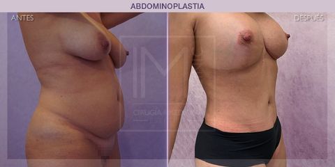 Abdominoplastia - IM CLINIC