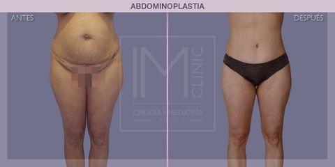 Abdominoplastia - IM CLINIC