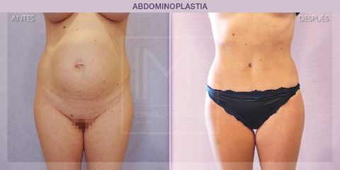 Abdominoplastia - IM CLINIC