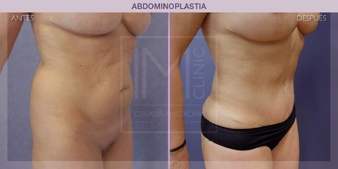 Abdominoplastia - IM CLINIC