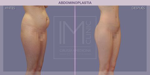 Abdominoplastia - IM CLINIC