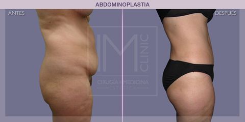 Abdominoplastia - IM CLINIC