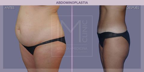 Abdominoplastia - IM CLINIC