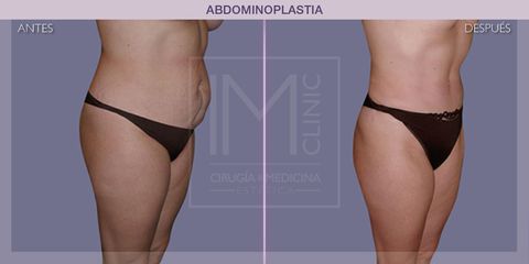Abdominoplastia - IM CLINIC