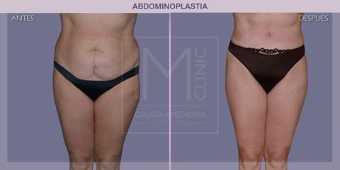 Abdominoplastia - IM CLINIC
