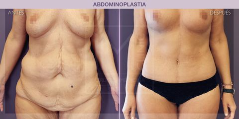 Abdominoplastia - IM CLINIC