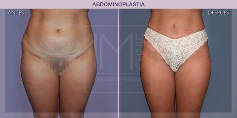 Abdominoplastia - IM CLINIC