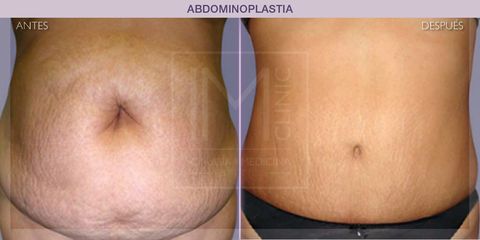 Abdominoplastia - IM CLINIC