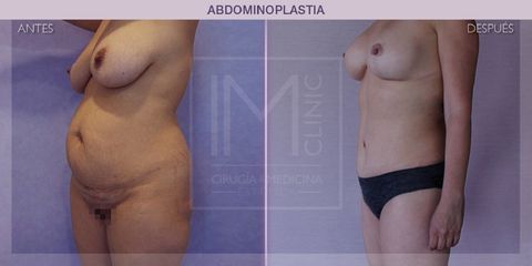 Abdominoplastia - IM CLINIC