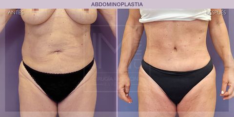 Abdominoplastia - IM CLINIC