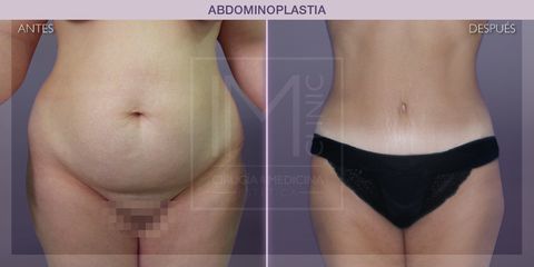 Abdominoplastia - IM CLINIC