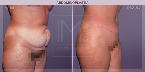 Abdominoplastia - IM CLINIC