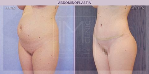 Abdominoplastia - IM CLINIC