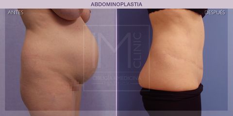 Abdominoplastia - IM CLINIC