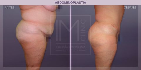 Abdominoplastia - IM CLINIC