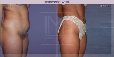Abdominoplastia - IM CLINIC