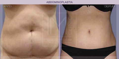 Abdominoplastia - IM CLINIC
