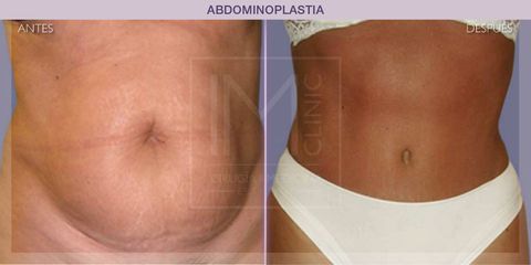 Abdominoplastia - IM CLINIC